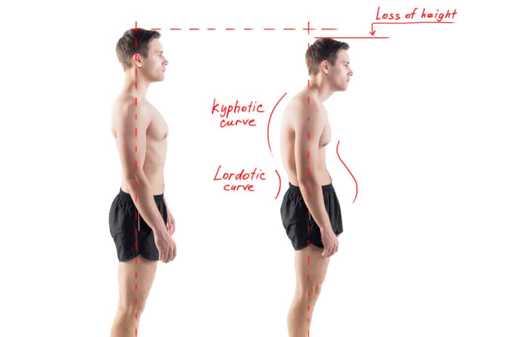 Man with impaired posture position defect scoliosis and ideal be