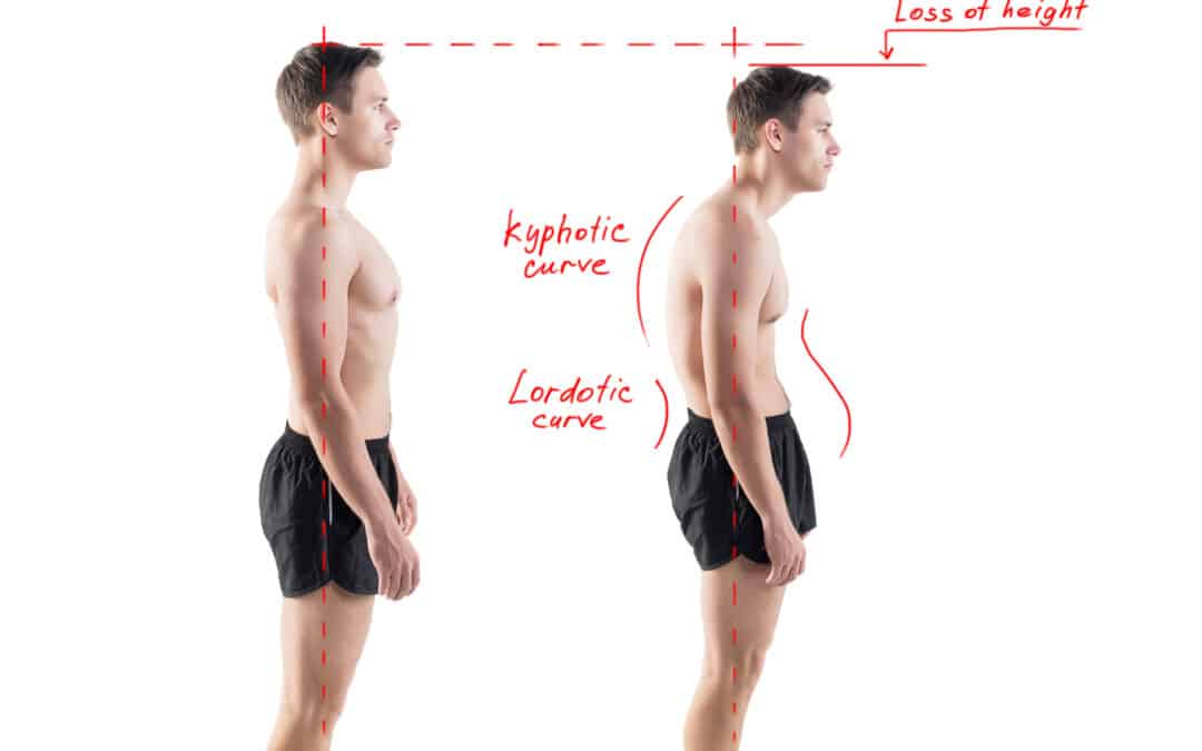 Man with impaired posture position defect scoliosis and ideal be