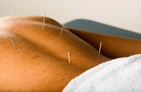 Sports medicine acupuncture highlight