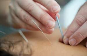 Acupuncture for injury and pain relief